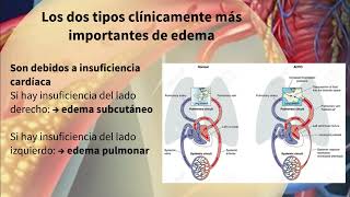 TEMA 7 1 FISIOPATOLOGÍA CARDIOVASCULAR Parte 1 video 1 Trastornos hemodinámicos Edema [upl. by Ynavoj]