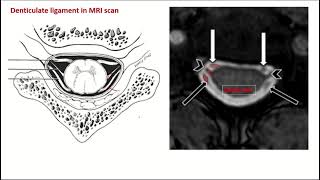 Denticulate ligaments pia mater [upl. by Waterman]