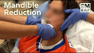 Mandible Reduction Classic Technique [upl. by Maddi]