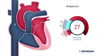 Langsame Herzrhythmusstörungen Bradykardie [upl. by Glogau]