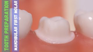 Mandibular First Molar 🔵 Tooth Preparation for PFM 🟡 Step by Step Demonstration [upl. by Staten]