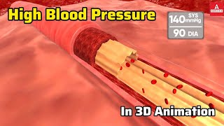 High Blood Pressure Explained in 3D  Understanding Hypertension [upl. by Onabru]