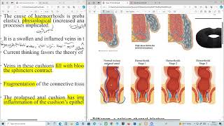 Haemorrhoids Clinical Pharmacy [upl. by Shane]