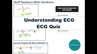 How to understand ECG from scratch and identify WPW syndrome and AV Blocks on an ECG [upl. by Andreas]