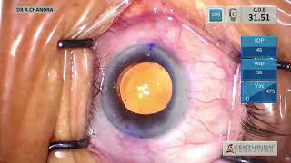 Phacoemulsification Cataract Surgery with Alcon Clareon PanOptix Toric IOL  Dr Anuradha Chandra [upl. by Turner555]