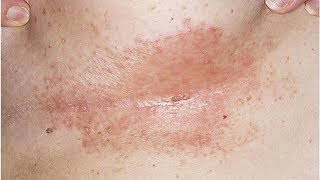 Natural Remedies for Intertrigo Candida of the Skin Folds [upl. by Eityak402]