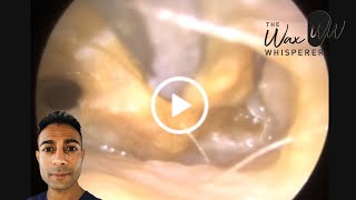 973  Ear Wax Removal in Severely Infected Ears [upl. by Reniar]