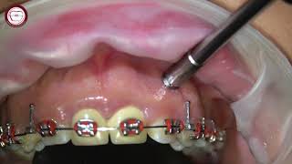 Miniscrew removal in orthodontics [upl. by Tore792]