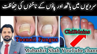 Miracle Treatment For Toenail Fungus amp Chilblains  سردیوں میں ہاتھ اور پاؤں کی انفیکشن سے حفاظت [upl. by Eednyl]