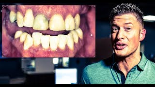 INVISALIGN IMPLANTS and Dental VENEERS  from PUERTO RICO for a SMILE Cosmetic Dentistry EP 3 [upl. by Idelle564]