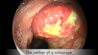 Stenotic colon cancer [upl. by Ecnesse]