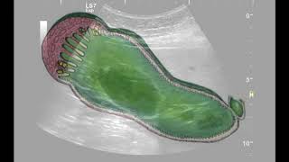 gallbladder fundal adenomyomatosis [upl. by Anippesuig174]