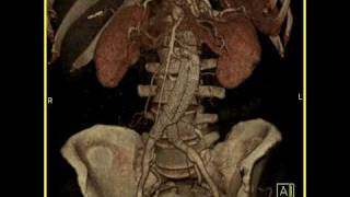 Aortic Stent Graft 3D imaging of a vascular stent in satisfactory position [upl. by Lucier]