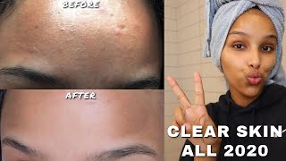 HOW I CLEARED TINY BUMPS AND TEXTURE ON MY FACE  GET SMOOTH SKIN [upl. by Eceeryt]