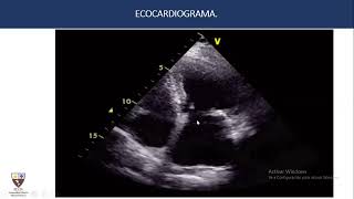 Infarto de miocardio sin obstrucción coronaria significativa Ateneo [upl. by Combs]