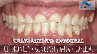 Tratamiento integral ortodoncia  gingivectomía  carillas [upl. by Lindsy]