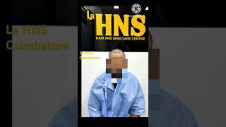 La HNS Hair Transplant High density Natural Hair Line shorts [upl. by Lucie329]