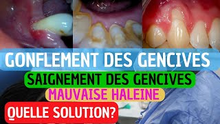 Pourquoi Vos Gencives Saignent  Causes Prévention et Traitement de la Gingivite [upl. by Irneh221]