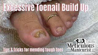 Incredible Pincer Toenail Makeover A Transformation [upl. by Kristan747]