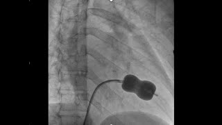 percutaneous mitral commissurotomy part II [upl. by Tristram]