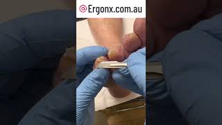 Tip of toe hard skin callus removal in podiatry clinic can be so satisfying [upl. by Smail876]