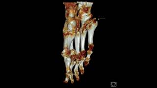 5th metatarsal base fracture [upl. by Atikam]