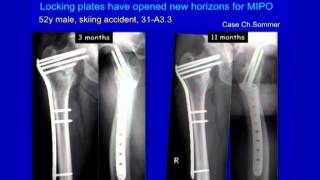 Complex Proximal Femur Fractures [upl. by Zap624]