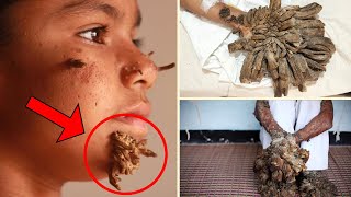 The MOST BIZARRE Skin Disorder Unveiling The Mystery Of TreeMan Syndrome Incredible facts [upl. by Anillehs816]