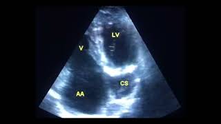 Coronary sinus mimicking a cyst to drahmadmirdamadisikTUfcNTCW7N2iR8 [upl. by Nnauol209]