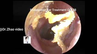 Satisfying Ear Wax Removal With Dr Zhao Video 20211028 [upl. by Arihsa]