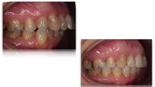 Ortodoncia dientes adelantados Clase 2 con extracciones [upl. by Yuma]