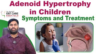 Symptoms and Treatment for Adenoid Hypertrophy in Children  Dr Harika ENT Care Hospital [upl. by Narmis]