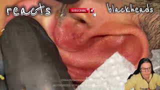 blackhead in ear blackhead in ear removal blackhead in earring hole blackhead in ear extraction [upl. by Milburt]