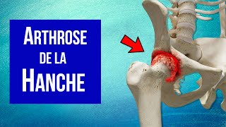 Arthrose de la hanche  Explication et Traitement [upl. by Dorotea142]