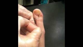 Draining a Subungual blister of toenail [upl. by Leirbag451]