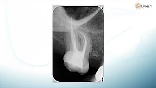 1 Obturation canalaire introduction  Endodontie [upl. by Ronaele]