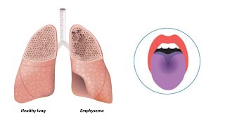 PULMONARY EMPHYSEMA FACE READING [upl. by Atsilac]