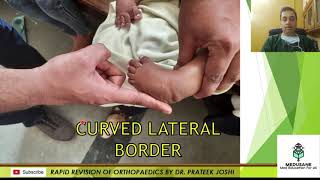 Congenital Talipes Equino Varus  Clinical Orthopaedics  Dr Prateek Joshi M S  MEDUSANE [upl. by Adolphe]