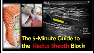 Rectus Sheath Block  A HowTo Guide [upl. by Oloapnaig654]