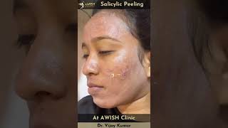 Peeling Treatment  Salicylic peel for pigmentation and acne peeling shorts awishclinic [upl. by Sinne]