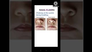 Nasal flaring  In tamil [upl. by Cram]