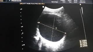 Bilateral Adnexal cystic Masses [upl. by Nagap]