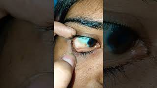 Conjunctival granuloma cyst chronic [upl. by Hgielyk205]