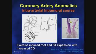 Adult Congenital Heart Disease Anomalous Coronary Arteries Risk Stratification [upl. by Amal]