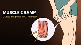 Muscle cramp Causes Signs and Symptoms Diagnosis and Treatment [upl. by Ddart]