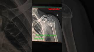 Proximal humerus fracturexray subscribe support ytshorts viralshorts [upl. by Camden]