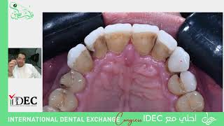 مع النجم المصري الدكتور عبدالله فاروق وضيف الIDEC لهذه الحلقة Veneers gone wrong [upl. by Eneliak]