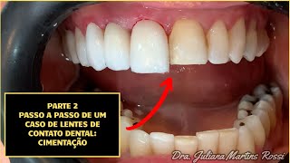 Caso de Lentes de Contato Dental Pt 2  Técnica de Cimentação das Lentes [upl. by Ayama]