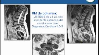 NeurorgsnetColocación de tornillos transpediculares con ayuda de neuronavegador3d [upl. by Latisha135]