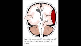 Herniation Syndromes  Cingulate subfalcine Transtentorial Uncal amp Cerebellar Tonsillar [upl. by Kaila]